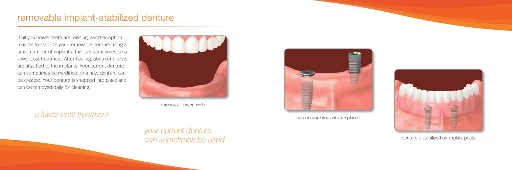 Dental Implants Billings MT