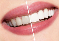 Teeth Whitening Billings MT