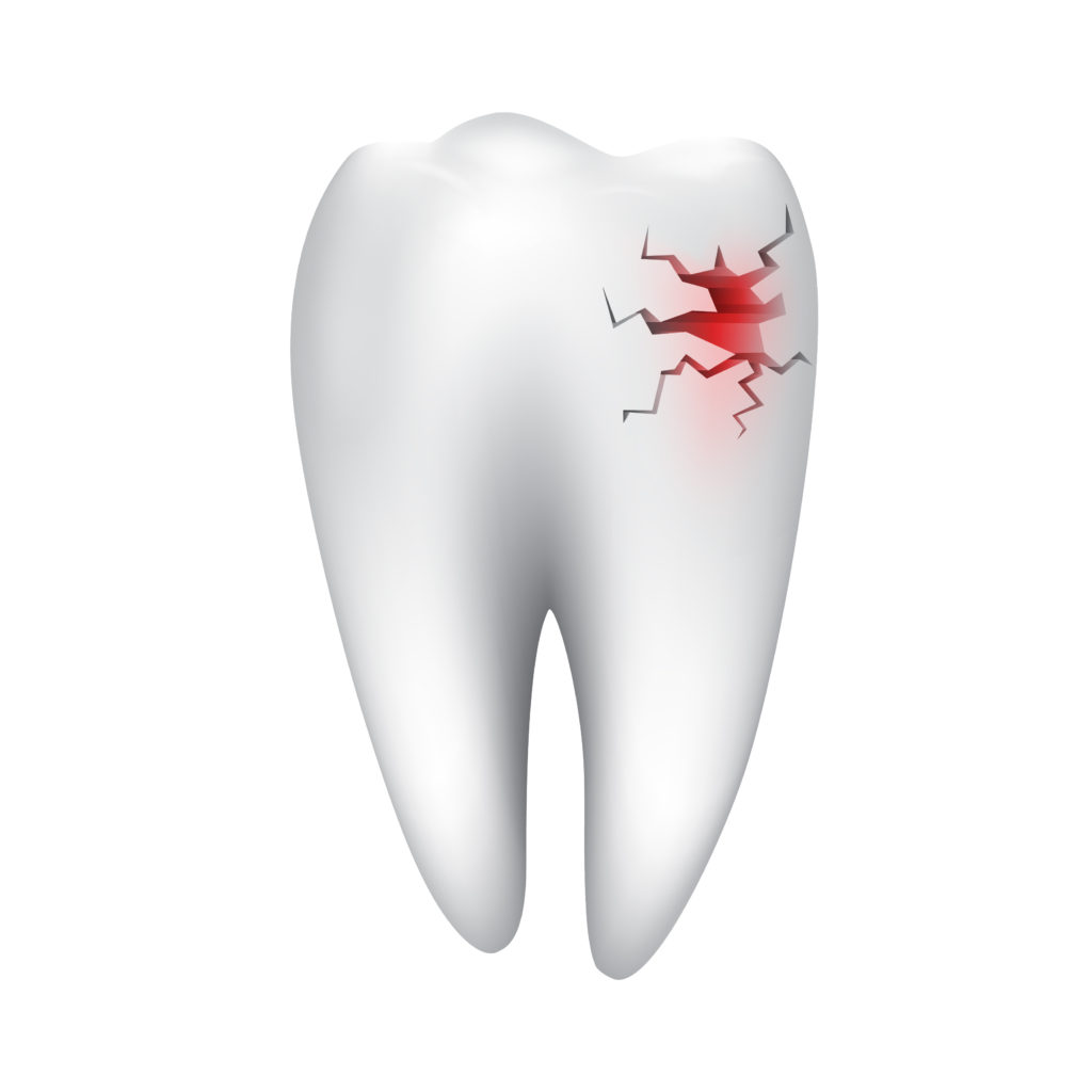 Cracked Tooth Treatment Billings MT